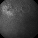 Wet Age Related Macular Degeneration (WET AMD) Wet Age Related Macular Degeneration (WET AMD)